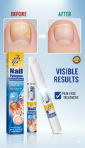 Advanced Nail Fungus Treatment - Fast Acting Antifungal Solution